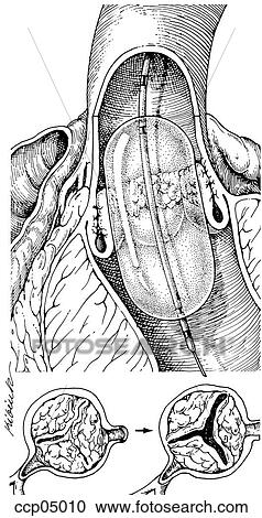 Balloon dilation of the aortic valve View Large Illustration Clipart - Balloon dilation of the aortic valve. Fotosearch