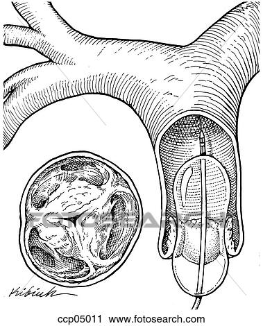 Clip Art - Balloon valvuloplasty in pulmonary stenosis. Fotosearch