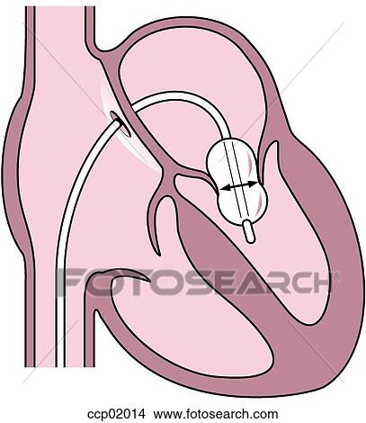 Balloon valvuloplasty View Large Illustration Stock Illustration - Balloon valvuloplasty. Fotosearch