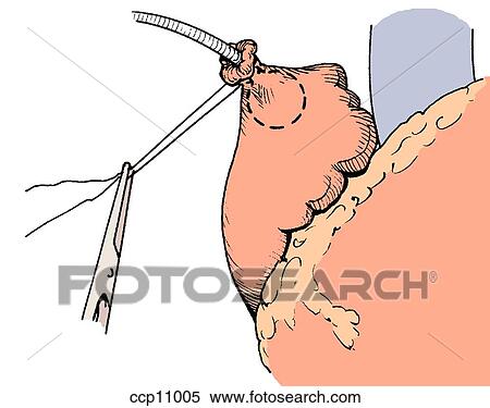 Blunt atrial rupture, step 1 View Large Illustration Stock Illustration - Blunt atrial rupture, step 1. Fotosearch