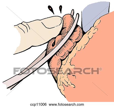 Blunt atrial rupture, step 2 View Large Illustration Stock Illustration - Blunt atrial rupture, step 2. Fotosearch