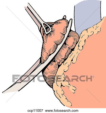 Blunt atrial rupture, step 3 View Large Illustration Stock Illustration - Blunt atrial rupture, step 3. Fotosearch