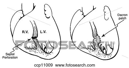 Blunt traumatic ventricular septal defect View Large Illustration Stock Illustration - Blunt traumatic ventricular septal defect. Fotosearch