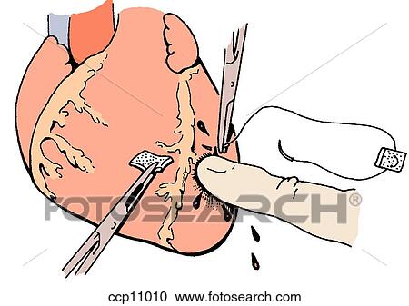 Blunt ventricular rupture, step 1 View Large Illustration Clipart - Blunt ventricular rupture, step 1. Fotosearch