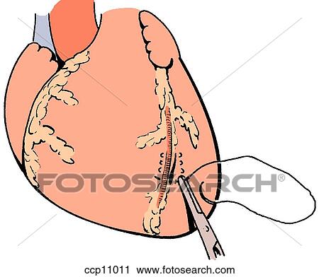 Clip Art - Blunt ventricular rupture, step 2. Fotosearch