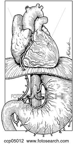 Bypass graft, coronary and gastroepiploic arteries View Large Illustration Drawing - Bypass graft, coronary and gastroepiploic arteries. Fotosearch