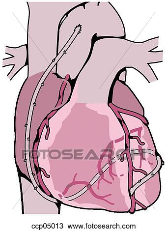 Bypass surgery, coronary View Large Illustration Drawing - Bypass surgery, coronary. Fotosearch