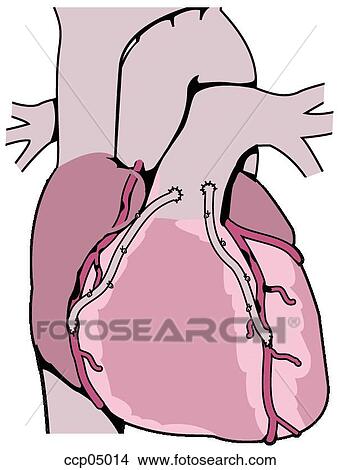 Bypass surgery, coronary View Large Illustration Stock Illustration - Bypass surgery, coronary. Fotosearch