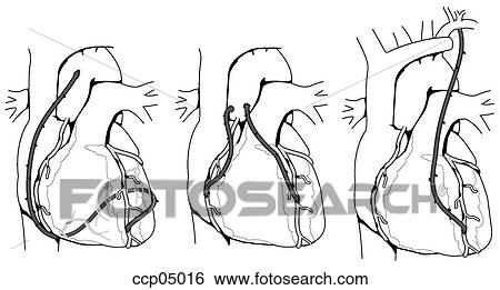 Stock Illustration - Bypass surgery, coronary. Fotosearch
