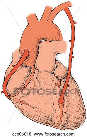 Stock Illustration - Bypass, surgery. Fotosearch