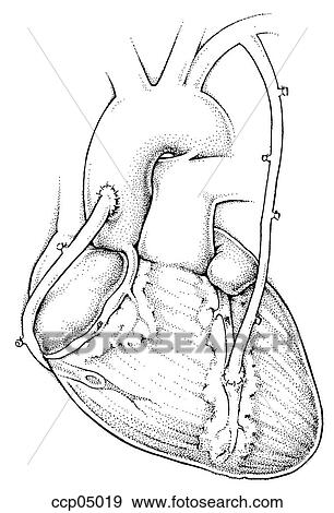 Bypass, surgery View Large Illustration Stock Illustration - Bypass, surgery. Fotosearch