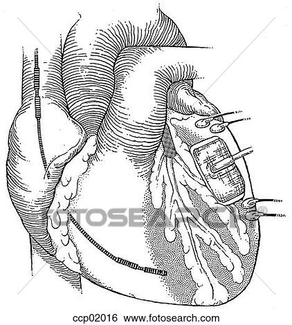Cardiac pacemaker View Large Illustration Stock Illustration - Cardiac pacemaker. Fotosearch