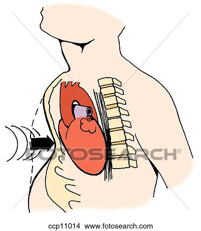 Cardiac rupture, compressive mechanism Stock Illustration | ccp11014 ...