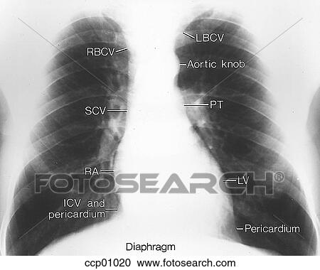 Cardiac silhouette, chest radiogram View Large Illustration Clipart - Cardiac silhouette, chest radiogram. Fotosearch