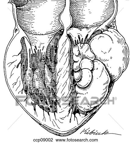 Cardiac tumors in children View Large Illustration Drawing - Cardiac tumors in children. Fotosearch