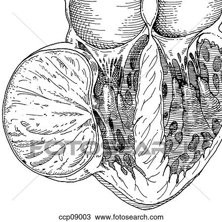 Cardiac tumors in children View Large Illustration Drawing - Cardiac tumors in children. Fotosearch