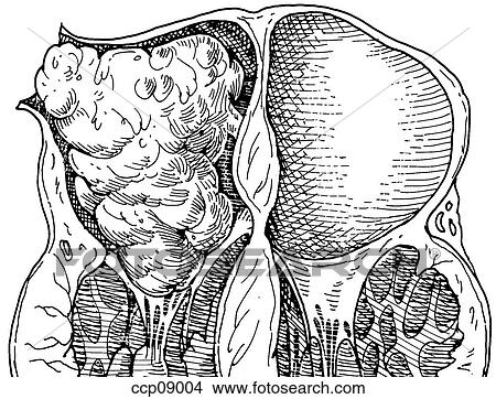 Cardiac tumors in children View Large Illustration Stock Illustration - Cardiac tumors in children. Fotosearch