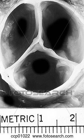 Drawing - Cardiac valve, aortic. Fotosearch