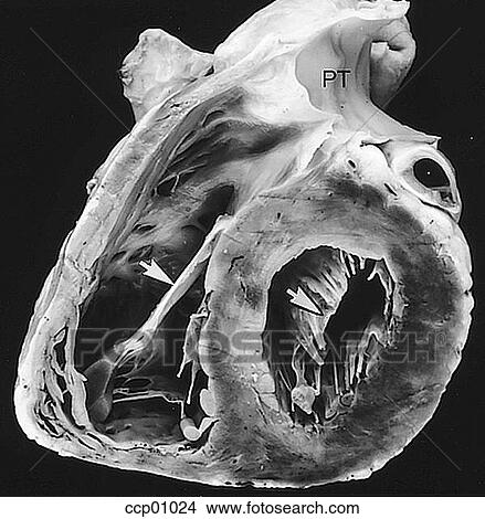 Cardiac valves, atrioventricular View Large Illustration Stock Illustration - Cardiac valves, atrioventricular. Fotosearch