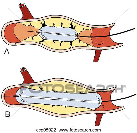 Catheter, balloon View Large Illustration Drawing - Catheter, balloon. Fotosearch