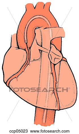 Drawing - Catheter, coronary. Fotosearch