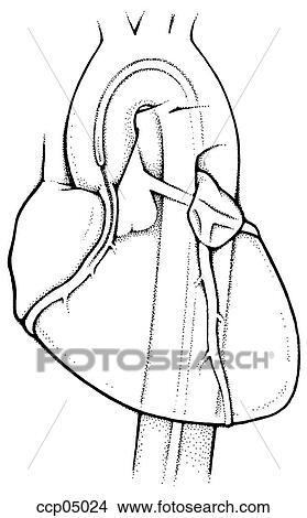 Catheter, coronary View Large Illustration Stock Illustration - Catheter, coronary. Fotosearch