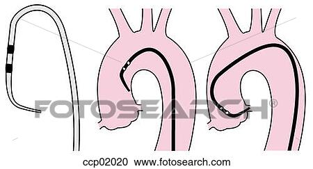 Clipart - Catheter, Judkins coronary. Fotosearch