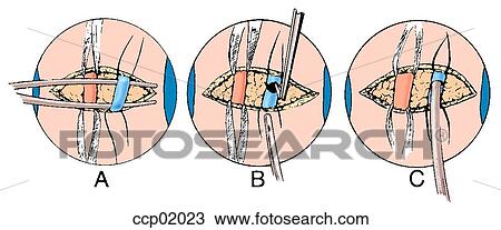 Drawing - Catheterization, brachial artery and vein. Fotosearch
