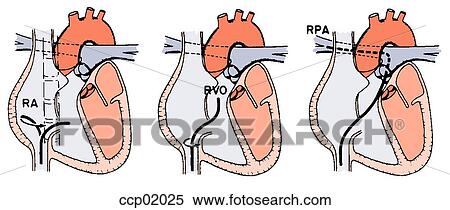 Right Catheterization Heart - Галерија слика