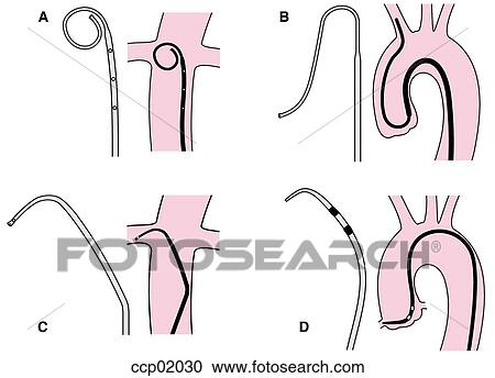 Clipart - Catheters, types. Fotosearch