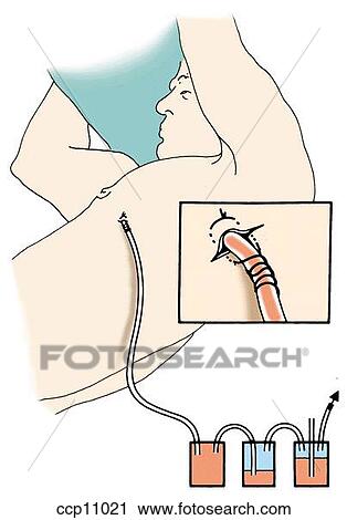 Chest tube View Large Illustration Clip Art - Chest tube. Fotosearch