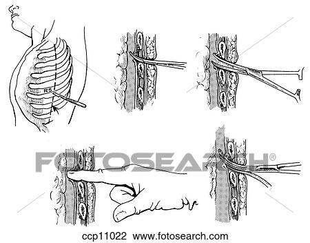 Drawing - Chest tube insertion. Fotosearch