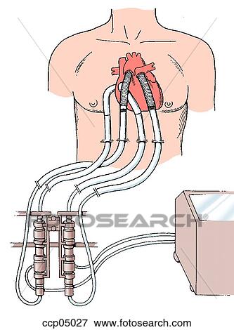 Circulatory support system View Large Illustration Stock Illustration - Circulatory support system. Fotosearch