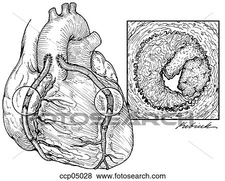 Stock Illustration - Coronary artery, acute occlusion of bypass graft. Fotosearch