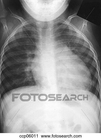 Clip Art - Defect, secundum atrial septal. Fotosearch