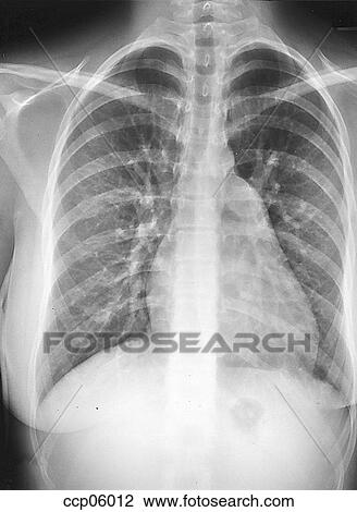 Drawing - Defect, secundum atrial septal. Fotosearch