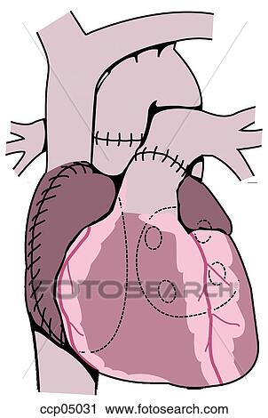Download Heart transplantation Clip Art | ccp05031 | Fotosearch