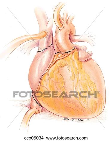 Heart transplantation View Large Illustration Stock Illustration - Heart transplantation. Fotosearch