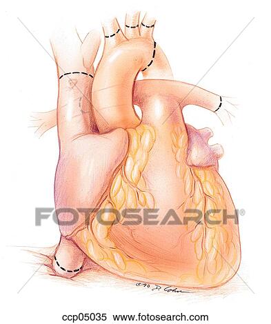 Heart transplantation View Large Illustration Stock Illustration - Heart transplantation. Fotosearch