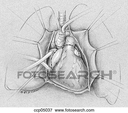 Heart/lung transplantation, step 1 View Large Illustration Stock Illustration - Heart/lung transplantation, step 1. Fotosearch