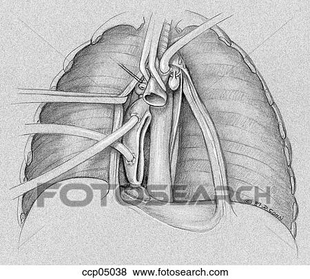 Heart/lung transplantation, step 2 View Large Illustration Stock Illustration - Heart/lung transplantation, step 2. Fotosearch
