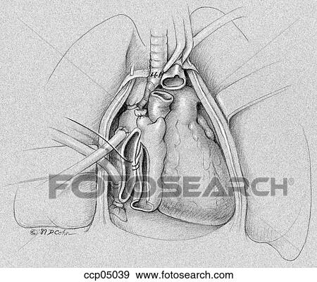 Heart/lung transplantation, step 3 View Large Illustration Stock Illustration - Heart/lung transplantation, step 3. Fotosearch