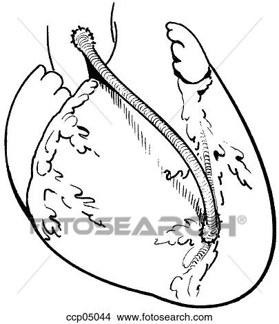 Stock Illustration - Injury, blunt coronary artery. Fotosearch
