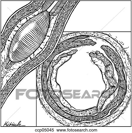 Injury, coronary a. wall following angioplasty View Large Illustration Stock Illustration - Injury, coronary a. wall following angioplasty. Fotosearch