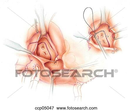 Maze procedure View Large Illustration Stock Illustration - Maze procedure. Fotosearch