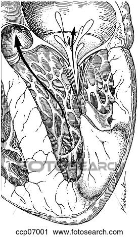 Mitral regurgitation in myocardial infarction View Large Illustration Clip Art - Mitral regurgitation in myocardial infarction. Fotosearch