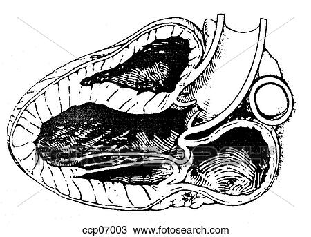 Drawing - Mitral valve prolapse. Fotosearch