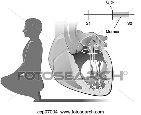 Mitral valve prolapse, squatting position View Large Illustration Stock Illustration - Mitral valve prolapse, squatting position. Fotosearch