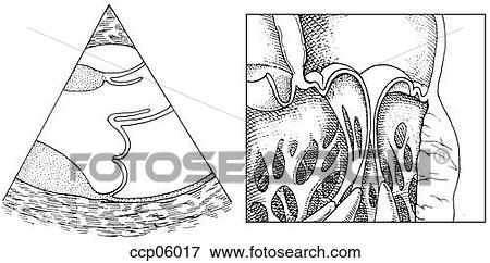 Mitral valve prolapse View Large Illustration Stock Illustration - Mitral valve prolapse. Fotosearch