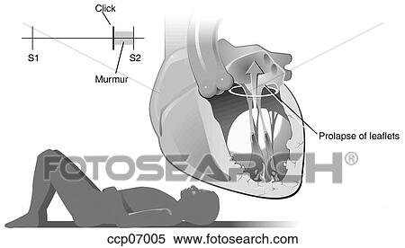 Stock Illustration - Mitral valve prolapse, supine position. Fotosearch